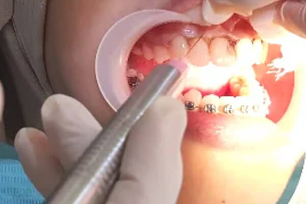 Crown Lengthening Gigi(1)