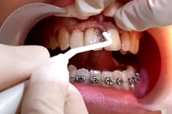 Operasi Gusi Periodontal(1)
