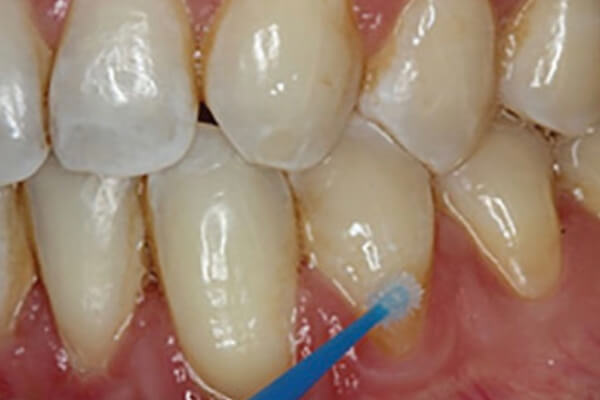 Terapi Gigi Hipersensitif(1)